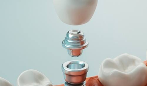 How dental implants work in San Marcos