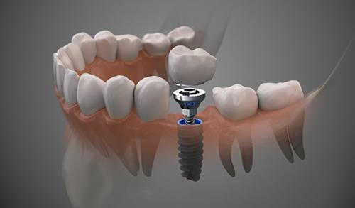 Digital image of dental implant parts