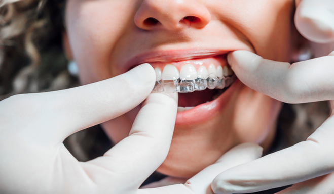 Smiling blonde woman holding an Invisalign aligner