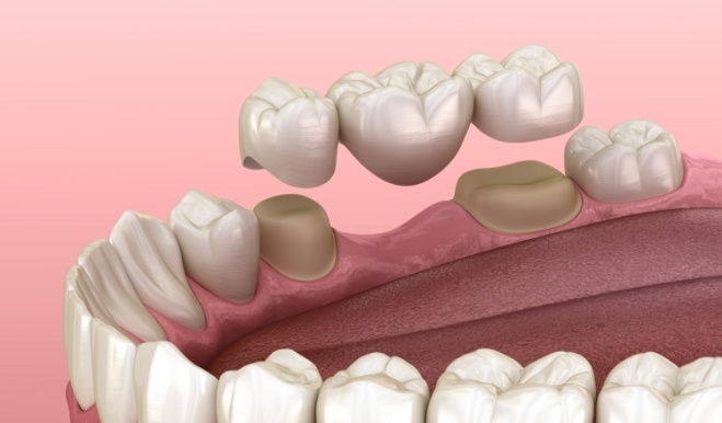Illustration of dental bridge being placed to replace a missing tooth