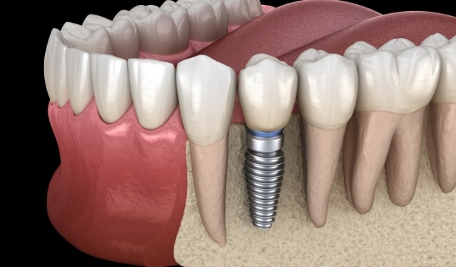 Illustrated dental implant in the lower jawbone replacing a missing tooth