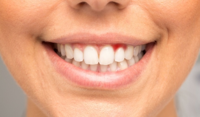 Close up of person with red spot in their gums