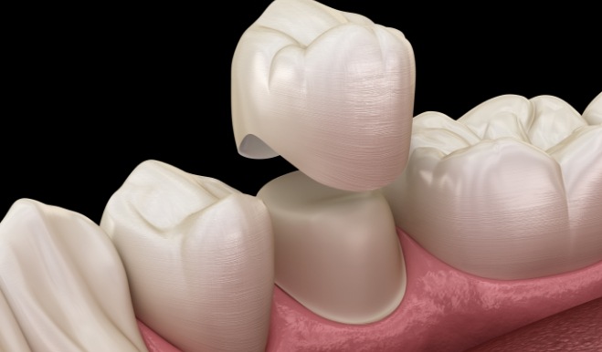 Illustrated dental crown being fitted over a tooth