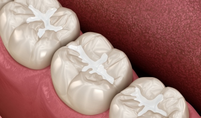 Illustrated row of teeth with white fillings