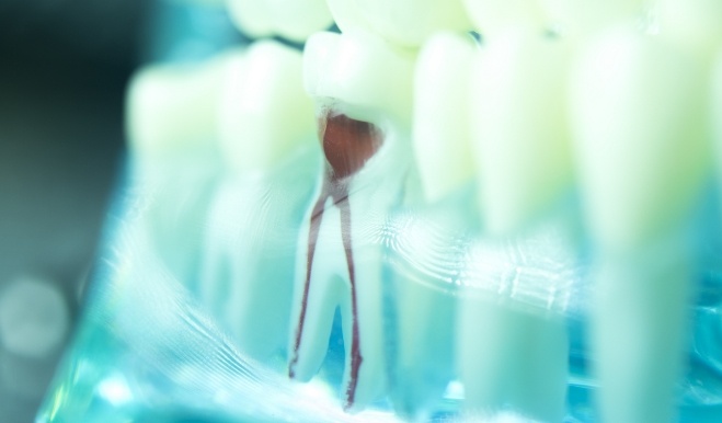 Model of tooth showing root canals inside of it