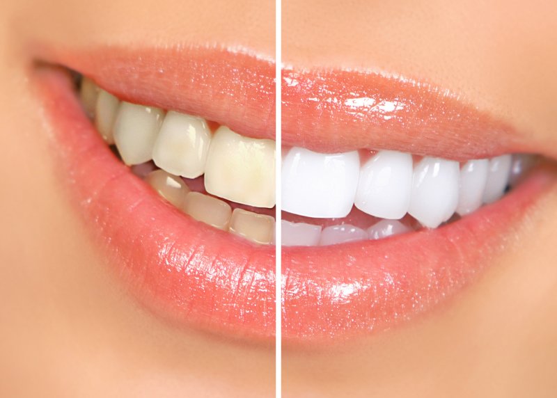 Teeth before and after cleaning