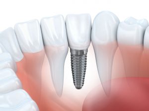 Image of implant in the jaw