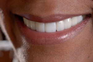 San Marcos porcelain veneers